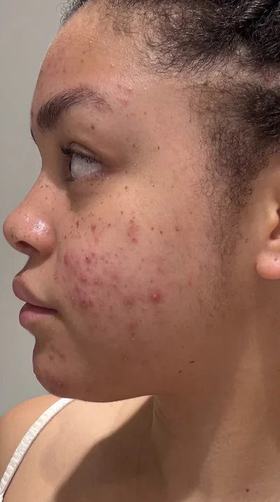 Rosacée — avant traitement