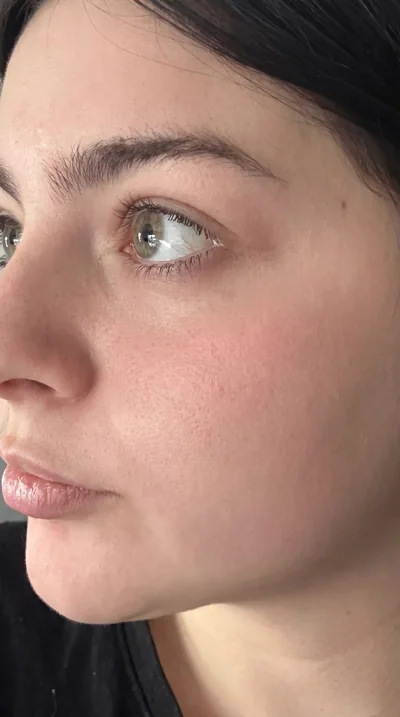 Hyperpigmentation — après 5 mois de traitement