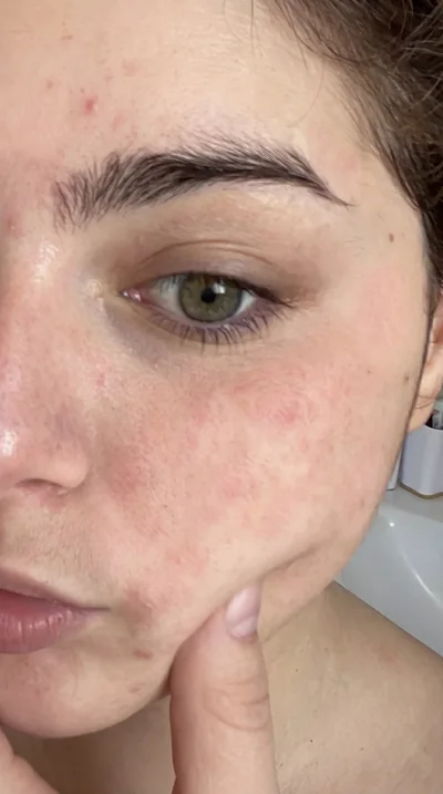 Hyperpigmentation — avant traitement