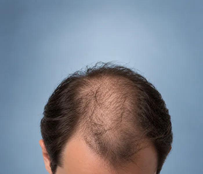 Amincissement général